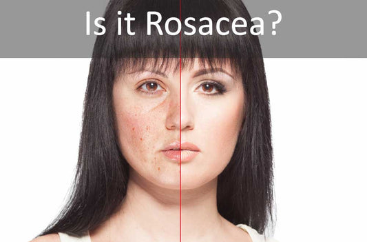 Rosacea Relief